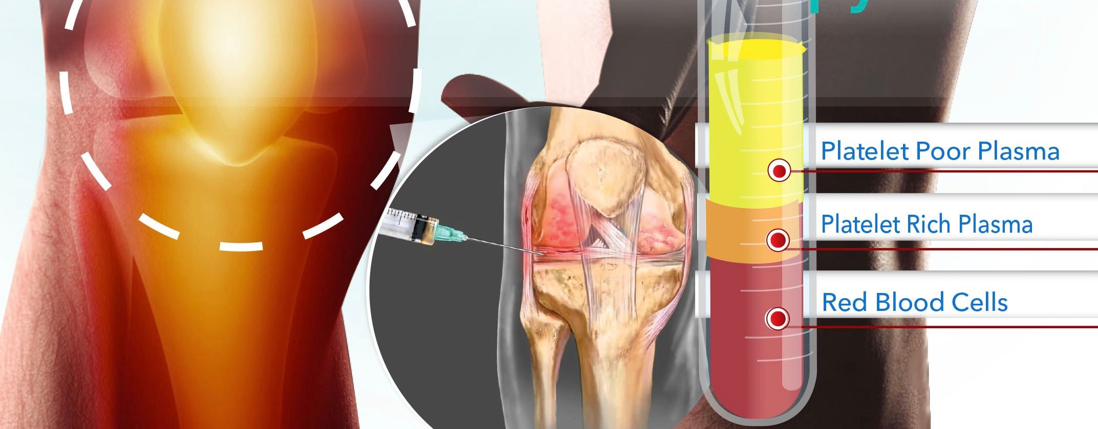 Platelet Rich Plasma Prp The Orthobiologic Clinic