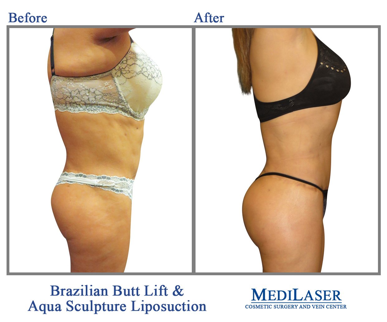 Brazilian Butt Lift BBL Before and After - Medilaser Surgery and Vein Center
