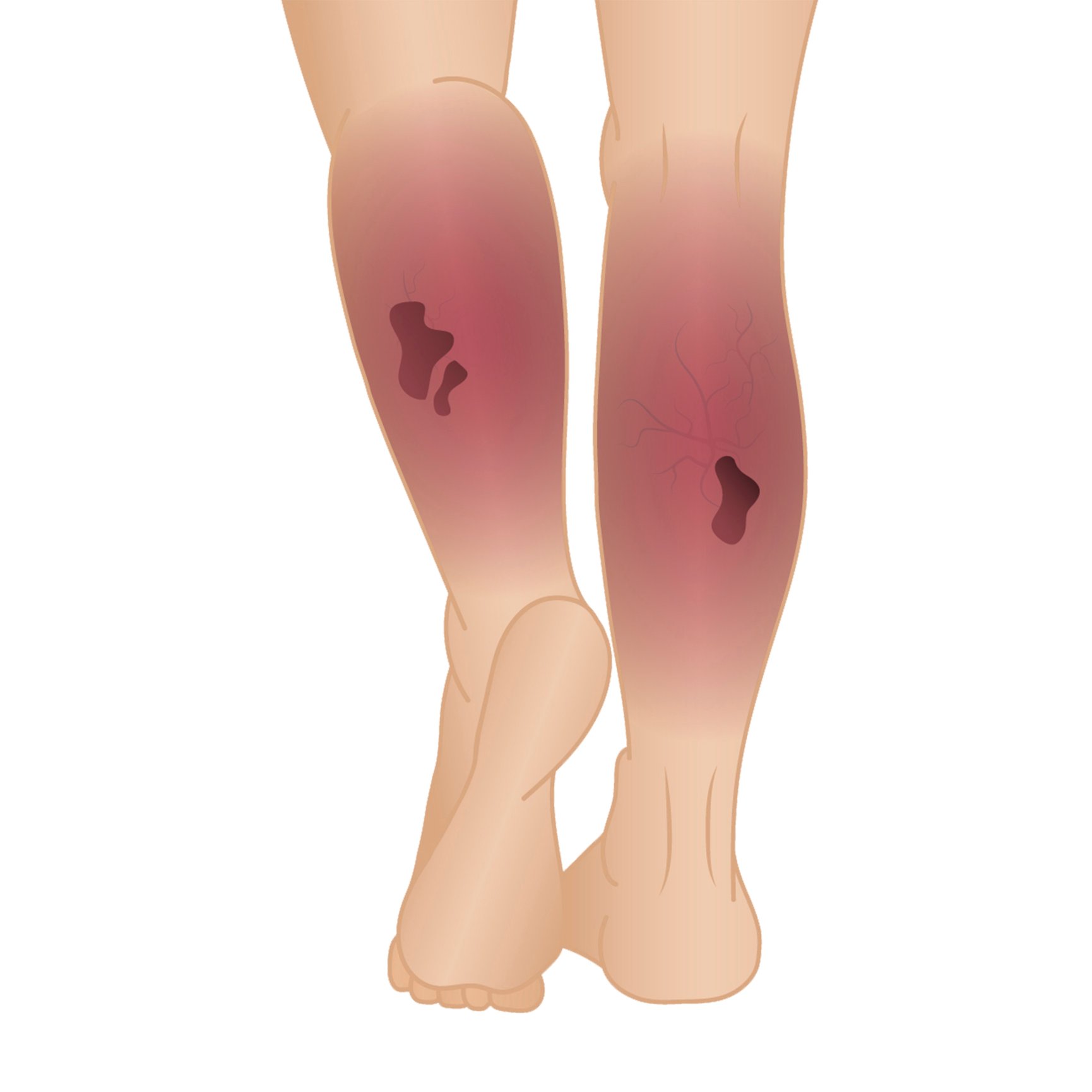 deep vein thrombosis behind knee