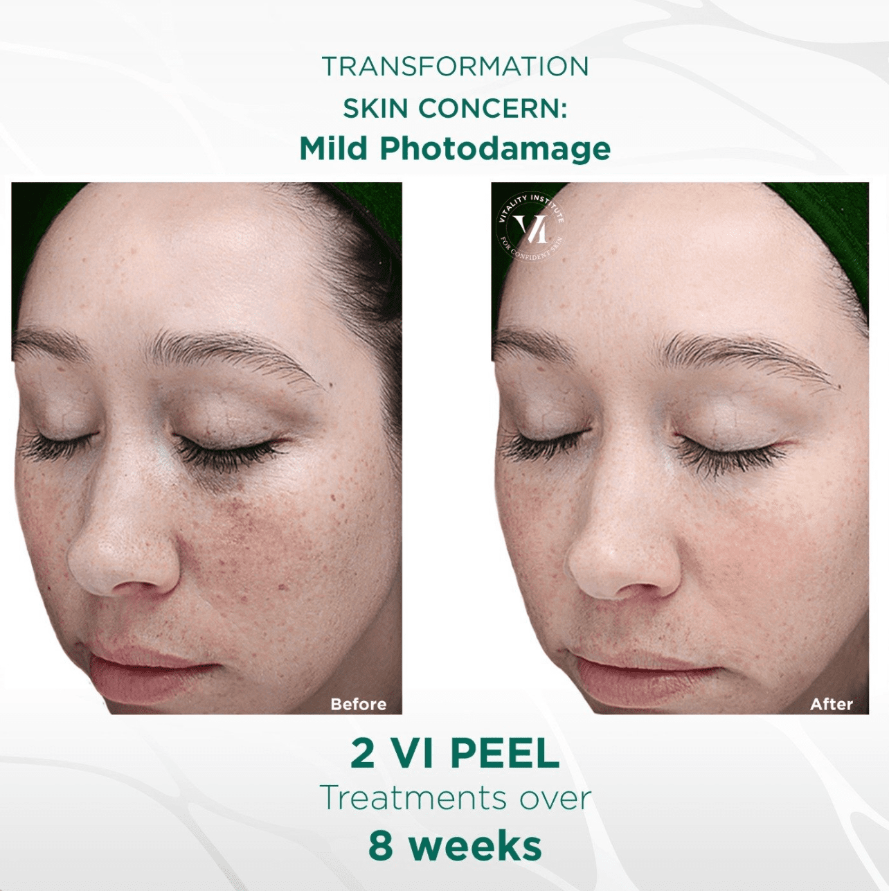 VI Peel Feel Ideal 360 Med Spa Southlake, TX