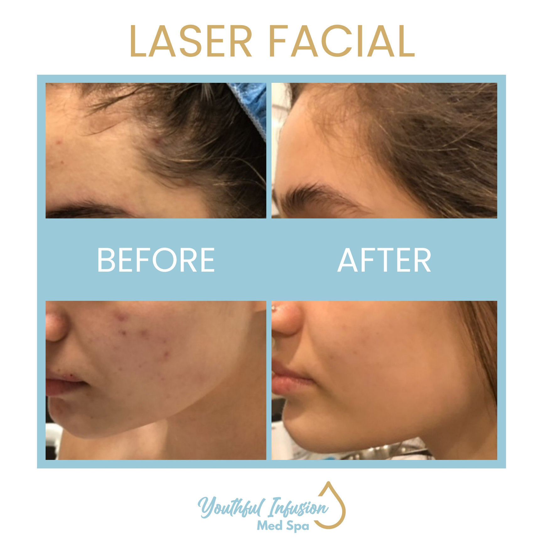 TIXEL Laser Facial | Allen, TX