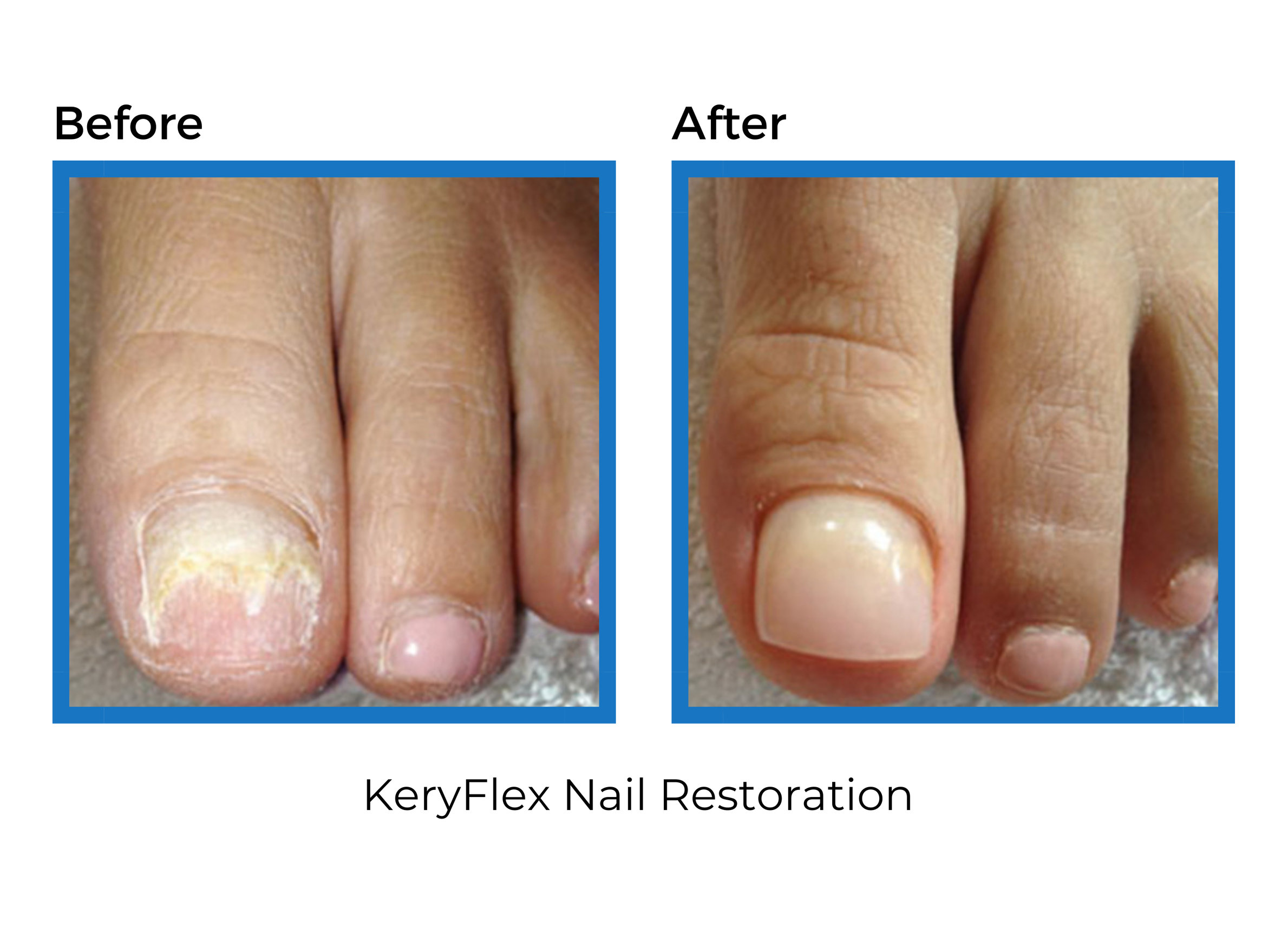 KeryFlex™ Nail Restoration System - Foot & Ankle Centers of Frisco and ...