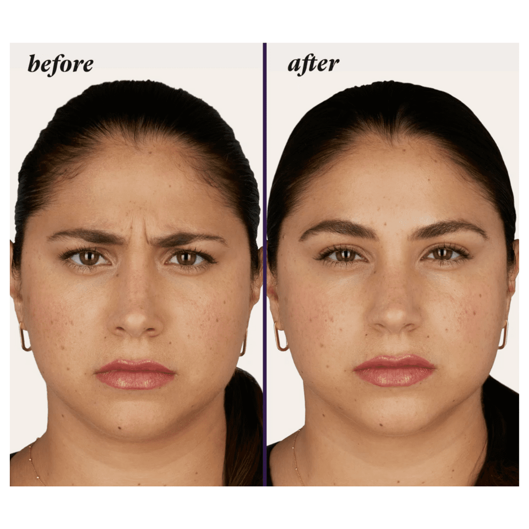 Botox Before And After Feel Ideal 360 Med Spa Southlake Tx