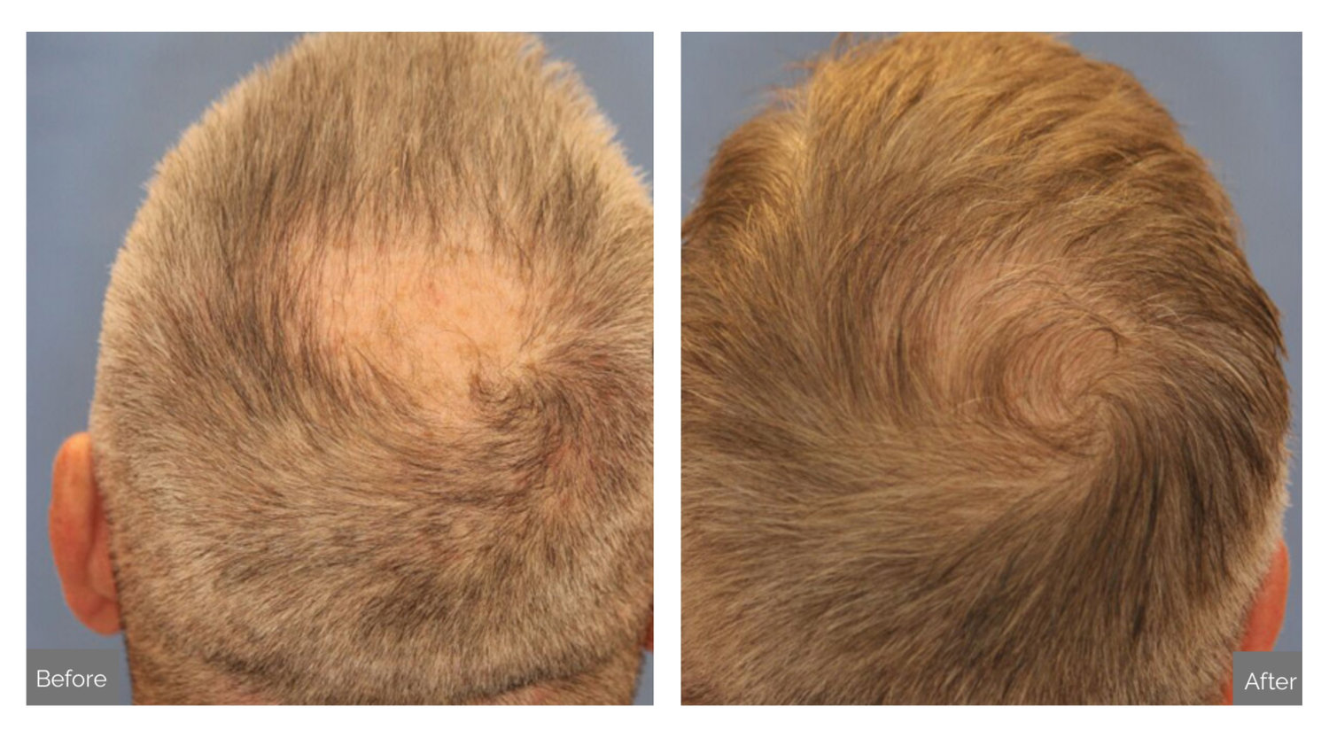 Hair Transplant Frisco Texas - Medilaser Surgery and Vein Center