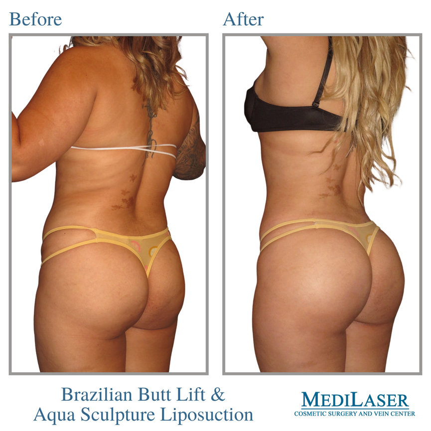 Brazilian Butt Lift (BBL): Before & After Photos Atlanta