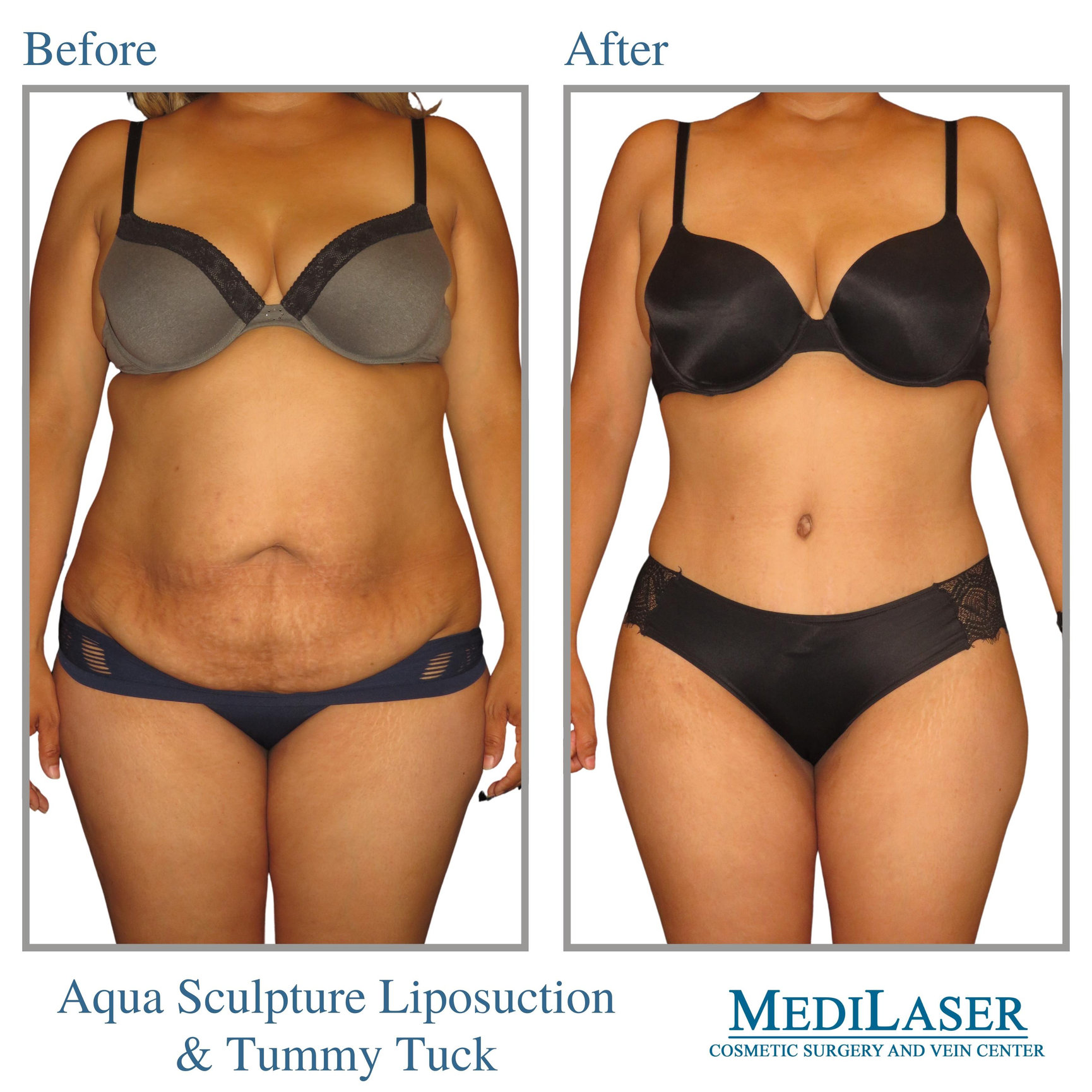 medial-thigh-lift-los-angeles-plastic-surgeon-dr-stoker-transforms