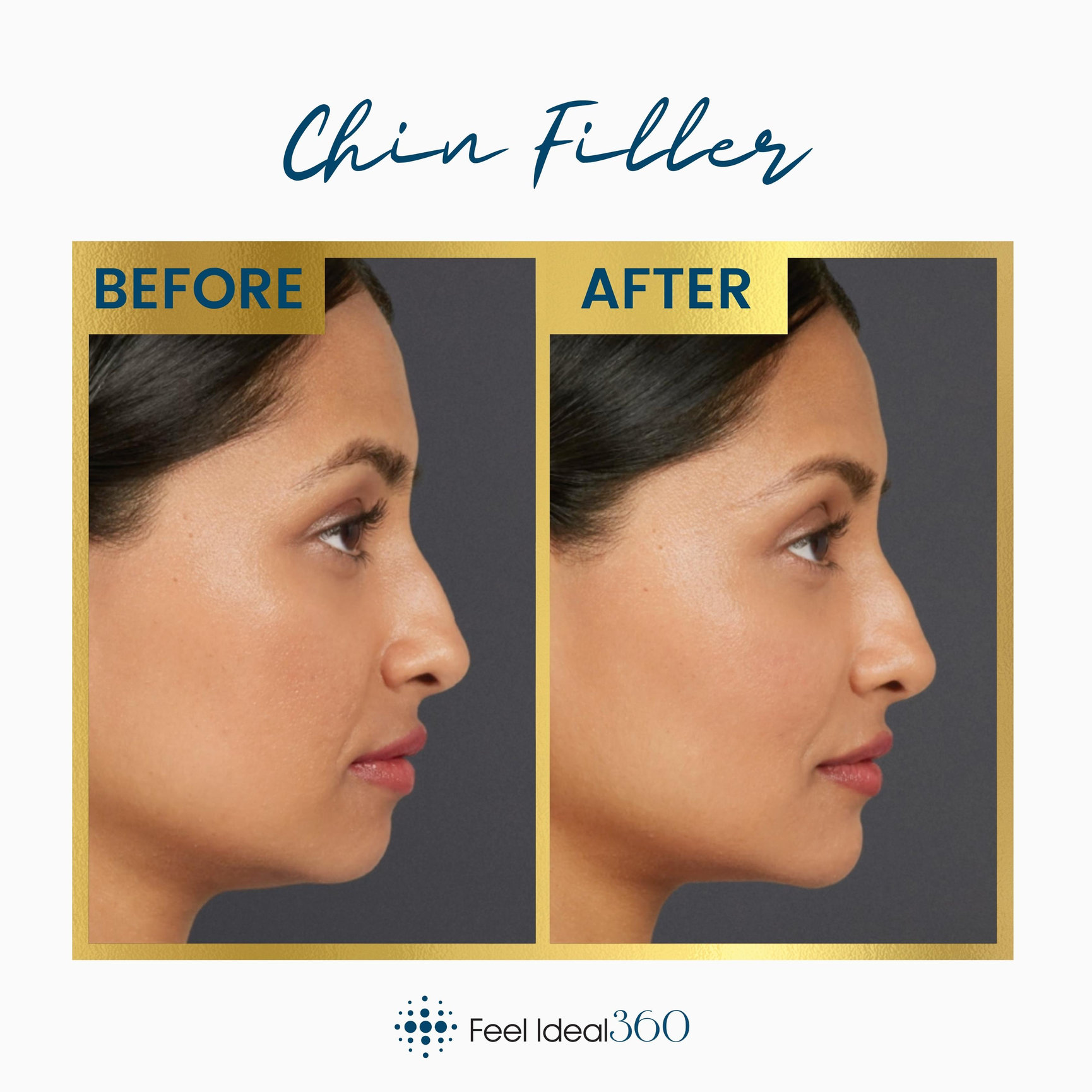 chin-implant-before-and-after-photo-gallery-scottsdale-az-hobgood