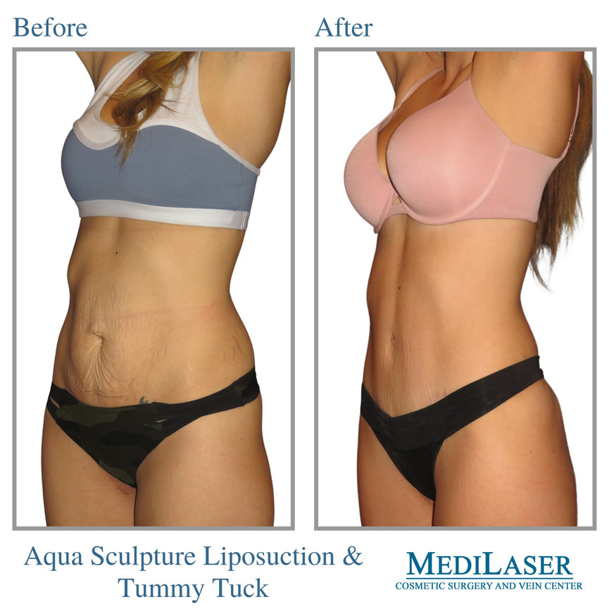 Tummy Tuck Before and After - Medilaser Surgery and Vein Center