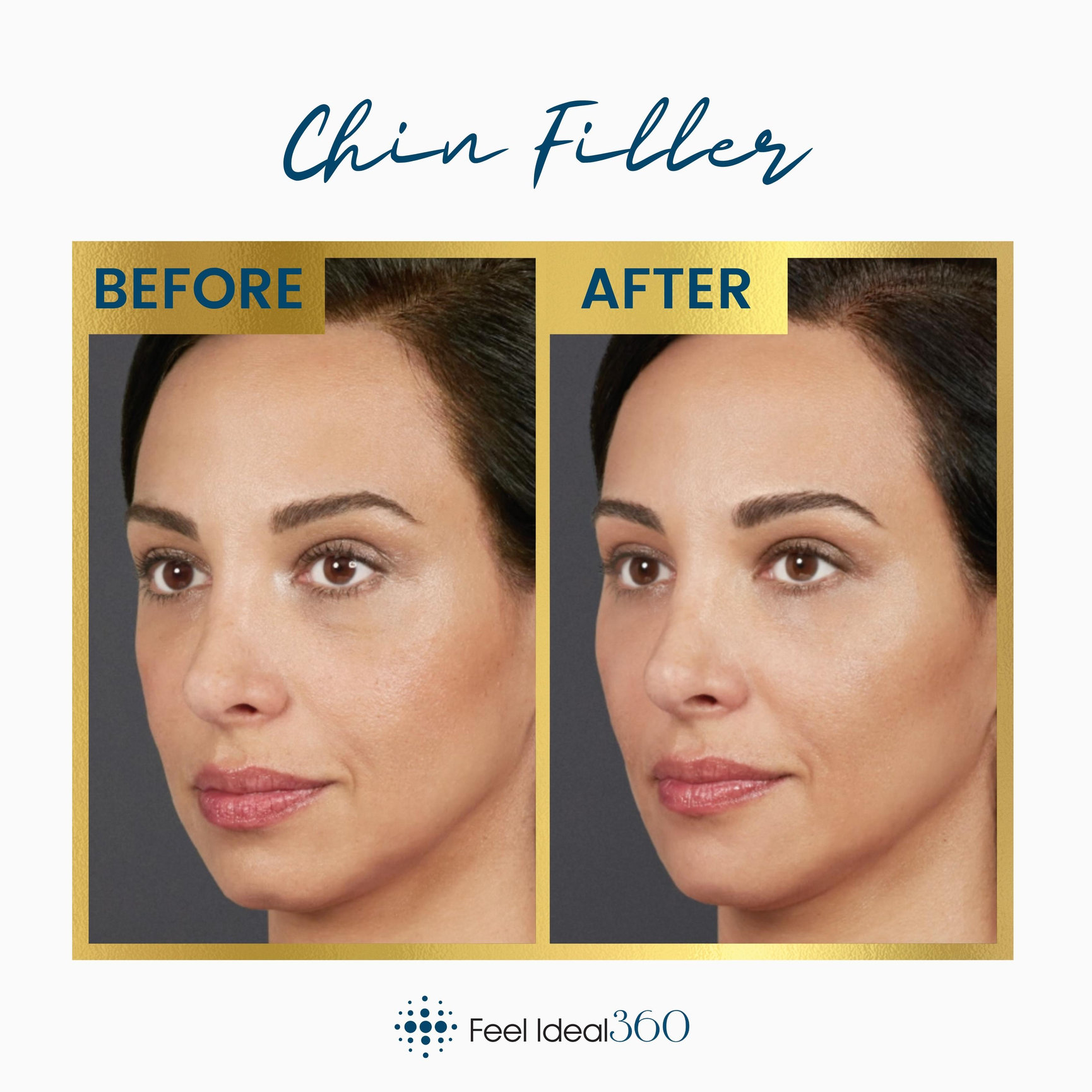 Chin Filler Before and After, overall - Feel Ideal 360 Med Spa ...