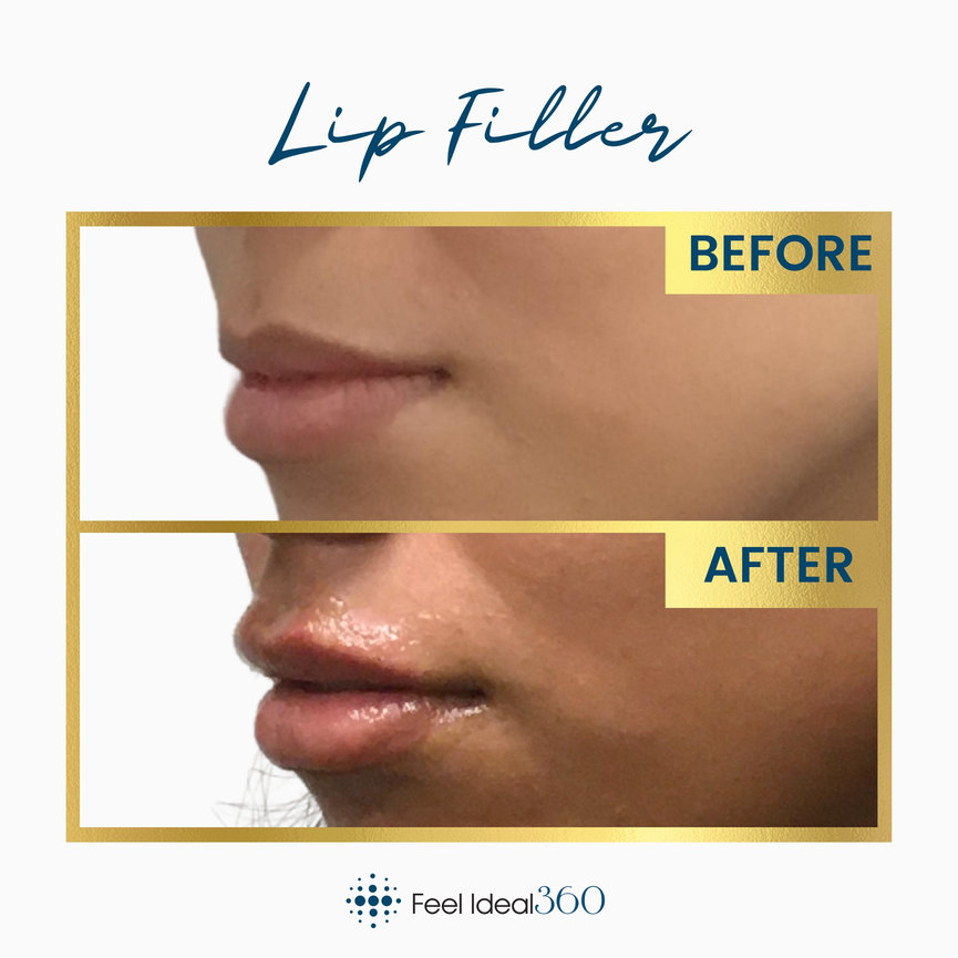 Lip Filler Before and After - Feel Ideal 360 Med Spa - Southlake, TX