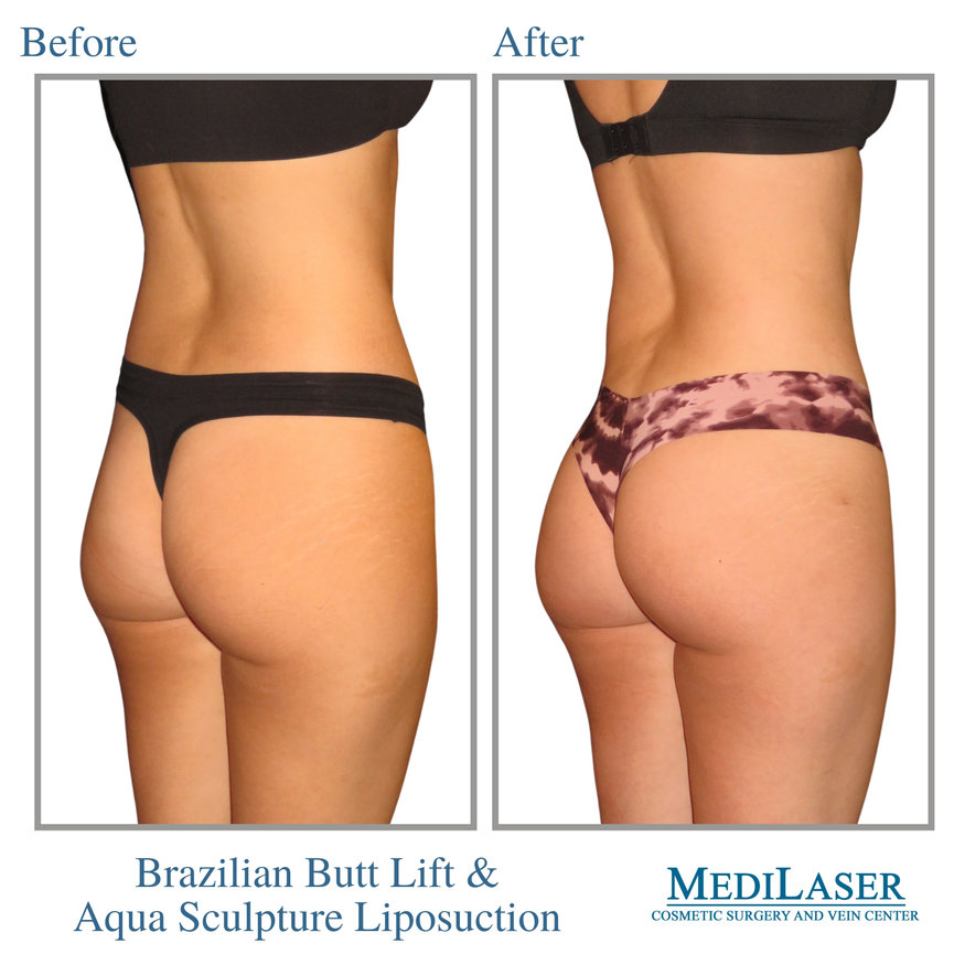 Brazilian Butt Lift Before and After Frisco Texas - Medilaser