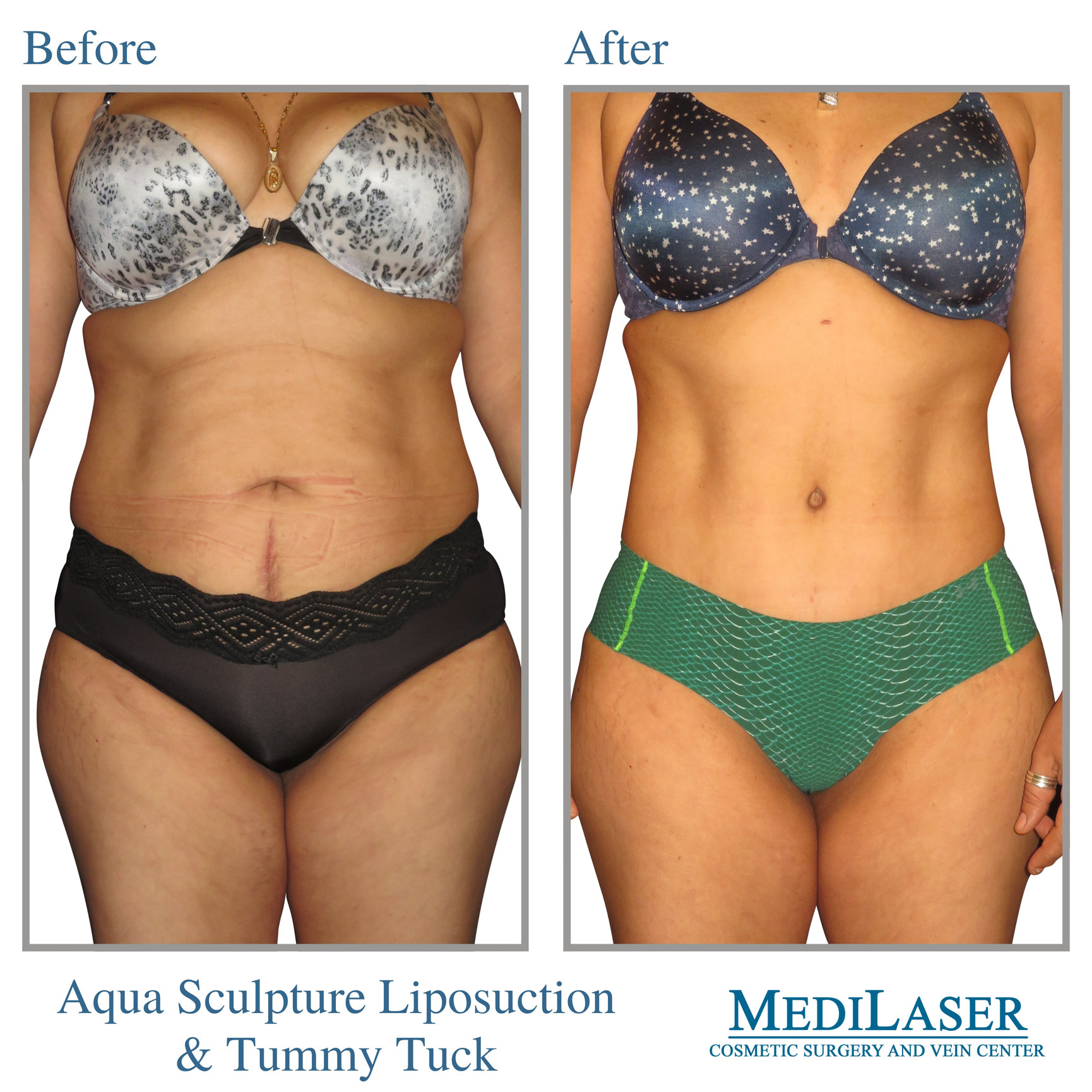 Tummy Tuck Liposuction Before and After - Medilaser Surgery and